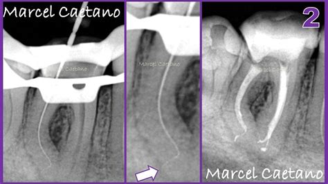 patencia endodontia.